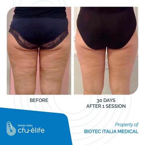 CFU-ELIFE_Before-After_06