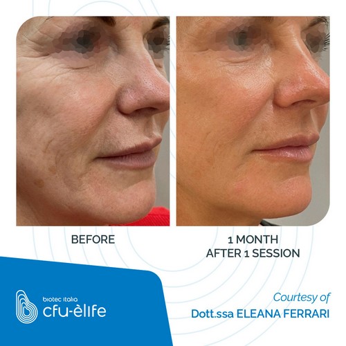 CFU-ELIFE_Before-After_10