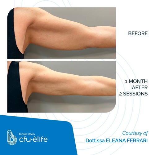CFU-ELIFE_Before-After_12